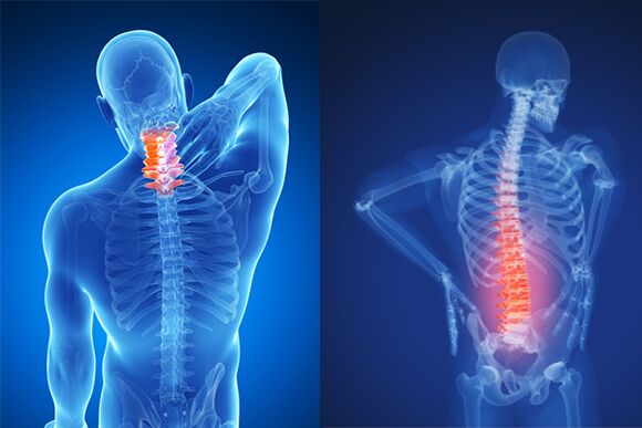 Osteochondrosis an spine cheirbheacsach agus lumbar
