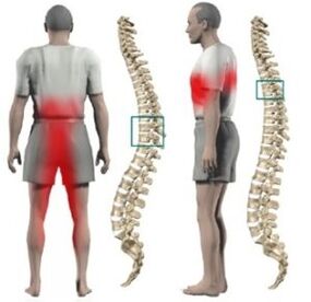 Protrusions sa spine