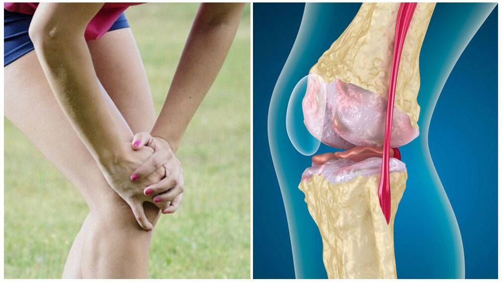 comharthaí arthrosis