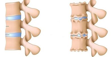 Conas láithreacht osteochondrosis an lumbar a aithint